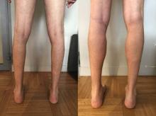 Augmentation du mollet - Patient 2