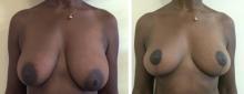 Ptose mammaire - Patient 6