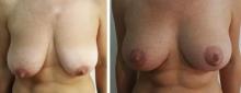Ptose mammaire - Patient 9