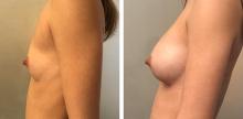 Augmentation mammaire par prothèses - Patiente 2
