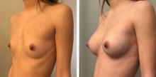 Augmentation mammaire par prothèses - Patiente 2
