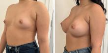 Augmentation mammaire par prothèses - Patiente 3