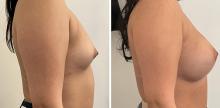 Augmentation mammaire par prothèses - Patiente 3
