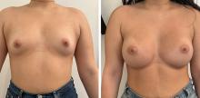 Augmentation mammaire par prothèses - Patiente 3