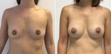 Augmentation mammaire par prothèses - Patiente 4