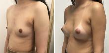 Augmentation mammaire par prothèses - Patiente 5