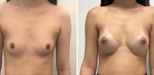 Augmentation mammaire par prothèses - Patiente 5