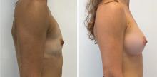 Augmentation mammaire par prothèses - Patiente 6