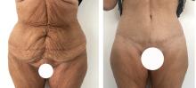 Abdominoplastie avant/apr&egrave;s