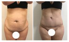 Abdominoplastie avant/apr&egrave;s