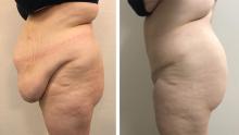 Abdominoplastie avant/apr&egrave;s