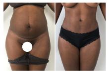 Abdominoplastie avant/apr&egrave;s