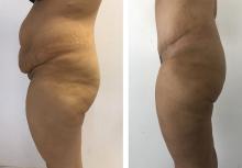 Abdominoplastie avant/apr&egrave;s