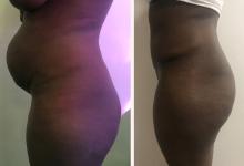 Abdominoplastie avant/apr&egrave;s