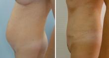 Abdominoplastie avant/après
