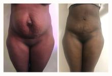 Abdominoplastie avant/après