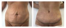 Abdominoplastie - Patiente 15