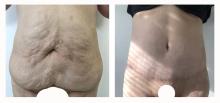 Abdominoplastie - Patiente 16