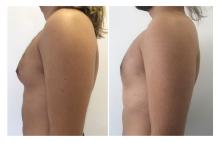 Gyn&eacute;comastie - Patient 1