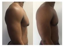 Gyn&eacute;comastie - Patient 3