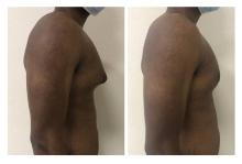 Gyn&eacute;comastie - Patient 4