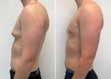 Gyn&eacute;comastie - Patient 5