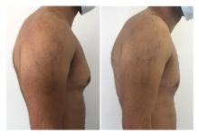 Gyn&eacute;comastie - Patient 6