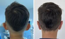 Otoplastie - Patient 01 apr&egrave;s