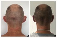 Otoplastie - Patient 02