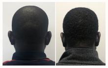 Otoplastie - Patient 04