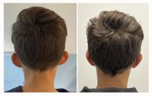 Otoplastie - Patient 05