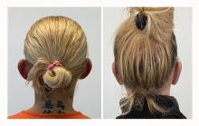 Otoplastie - Patient 10 apr&egrave;s