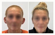 Otoplastie - Patient 10 avant