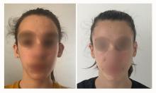 Otoplastie - Patient 12 avant