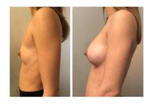 Augmentation mammaire par proth&egrave;ses - Patiente 02