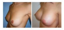 Augmentation mammaire par proth&egrave;ses - Patiente 03
