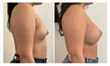Augmentation mammaire par proth&egrave;ses - Patiente 05