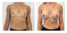 Augmentation mammaire par proth&egrave;ses - Patiente 10