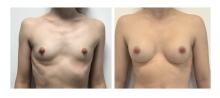 Augmentation mammaire par proth&egrave;ses - Patiente 11