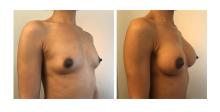 Augmentation mammaire par proth&egrave;ses - Patiente 13