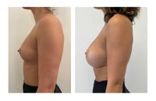 Augmentation mammaire par proth&egrave;ses - Patiente 14