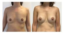 Augmentation mammaire par proth&egrave;ses - Patiente 15