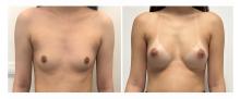 Augmentation mammaire par proth&egrave;ses - Patiente 17