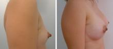 Augmentation mammaire par prothèses - Patiente 23