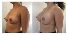 Augmentation mammaire par prothèses - Patiente 26