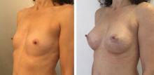 Augmentation mammaire par prothèses - Patiente 27