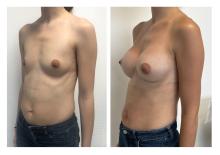 Augmentation mammaire par prothèses - Patiente 30