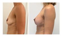 Ptose mammaire - Patient 09