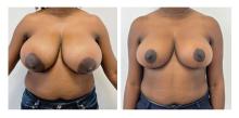 R&eacute;duction mammaire - Patiente 1