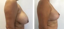 R&eacute;duction mammaire - Patiente 2